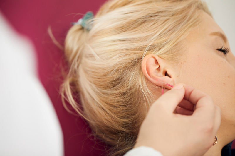 Ohrakupunktur Ohrakupunktur